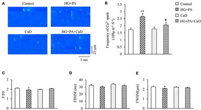 Calcium Dobesilate (CaD) Attenuates High Glucose and High Lipid-Induced Impairment of Sarcoplasmic Reticulum Calcium Handling in Cardiomyocytes